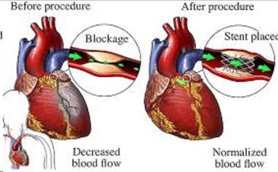 Dr. Gabe Mirkin on Health, Fitness and Nutrition. | Stents and Bypass